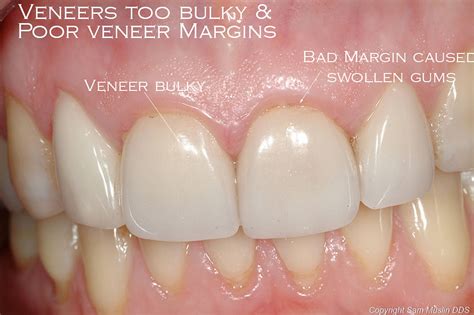 Why Some Veneers Look Natural and Others Don't