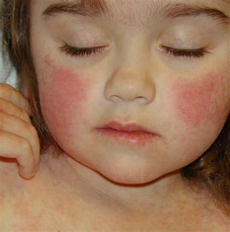 Rash on Face - Treatment, Causes, Pictures - HubPages