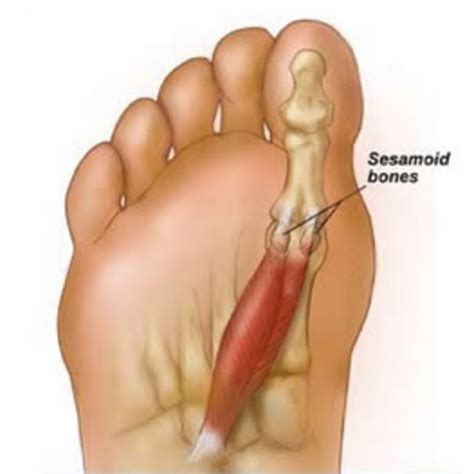 Sesamoiditis and the Sesamoid Bones | HubPages