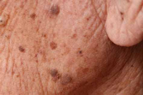 Seborrheic Keratosis (Skin Barnacles): Pictures, Cause, Removal