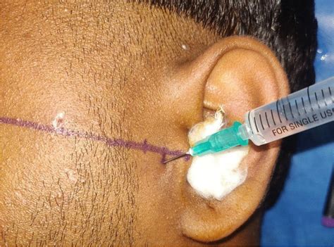 TMJ hematoma block being given with the same needle | Download Scientific Diagram