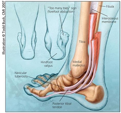 Posterior Tibial Tendon Insufficiency (Adult Acquired Flatfoot): An ...