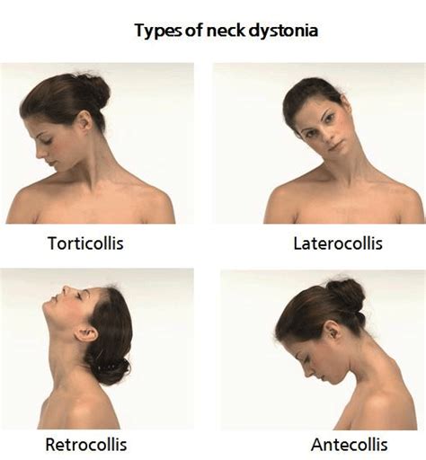 Cervical Dystonia | Have your Neck Pain Treated Now