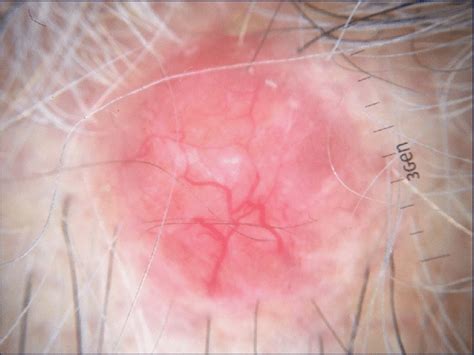 Dermatoscopic features of cylindroma within a scalp nodule. Arborizing ...