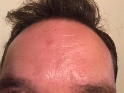 Advice requested for long-term sebaceous cyst on forehead ...