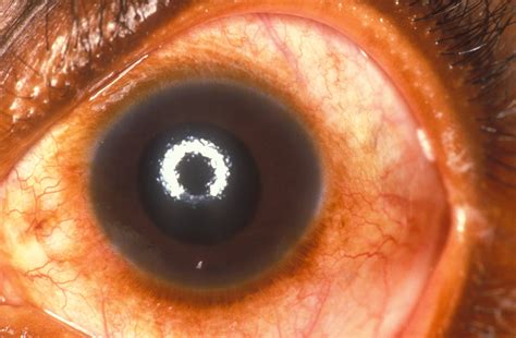 Corneal Edema Glaucoma