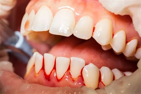 Is Gum Disease Serious? - Dentist in Owen's Cross Roads, AL