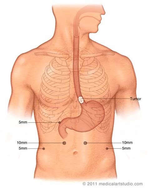 Mckeown Esophagectomy Incision : Thoraco Laparoscopic Ivor Lewis ...