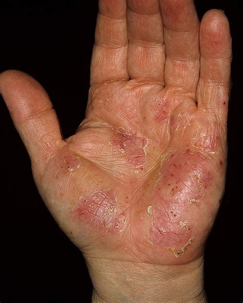 What causes blisters on palms of hands