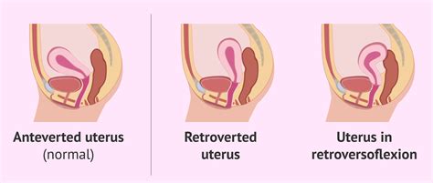 Uterus Tipped Backwards: Causes & Symptomes of Retroverted Uterus