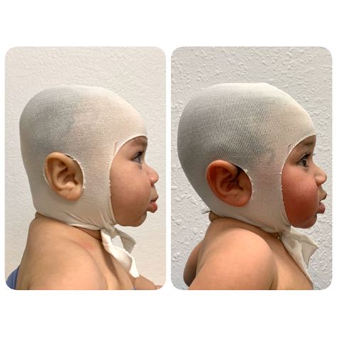 About Plagiocephaly – Children's Orthotics and Prosthetics