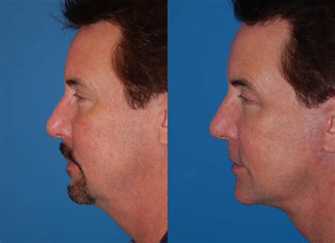 Male Facelift Photos | Melbourne, FL | Patient 29371