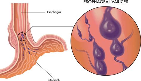 Esophageal varices: common complications resulting from cirrhosis