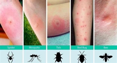 How to recognize various bug bites : coolguides | Insect bites and ...