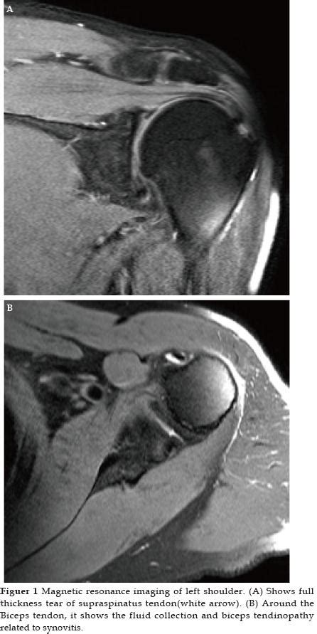 Radial Nerve Palsy after Arthroscopic Rotator Cuff Repair Caused by Functional Abduction Brace ...