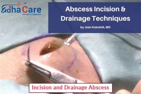 Incision and Drainage Abscess | Incision and Drainage Procedure