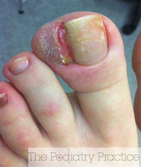 Wow, this is a severe ingrown toenail! - The Podiatry Practice