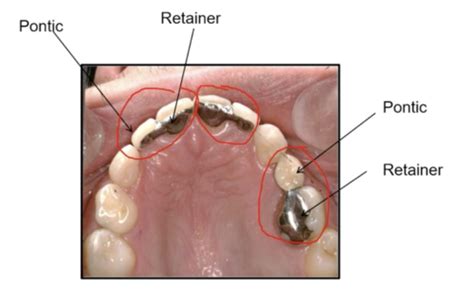 Resin Retained Bridge Flashcards | Quizlet