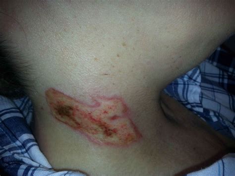 2nd-Degree Burns: Photos, Causes, Treatment