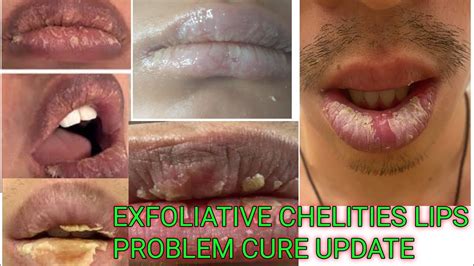 Cured From Exfoliative cheilitis 1Year Update| Dry/peeling lips ...