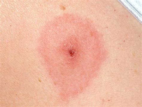 What Does A Tick Bite Rash Look Like | Images and Photos finder