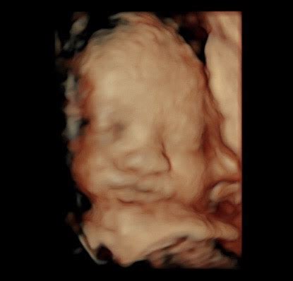 31 Week Ultrasound - Reveal 3D/4D Ultrasound Studio