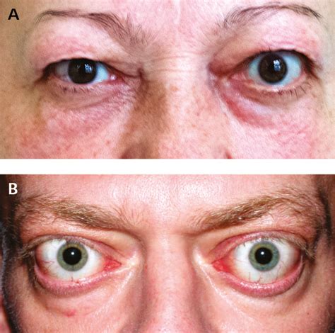 Figure 031_2_9057. Thyroid-associated orbitopathy. A, mild orbitopathy ...