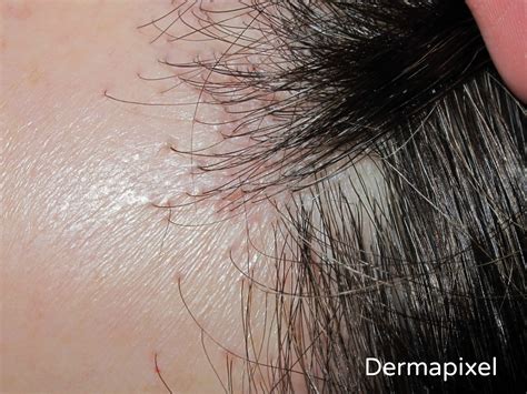 Dermapixel: Alopecia frontal fibrosante: cuando la frente se ensancha