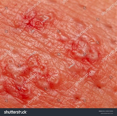 Close-up Wound Pus On Human Skin Stock Photo 2088234886 | Shutterstock