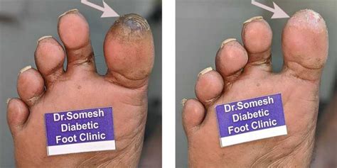 Diabetic Foot Gangrene stages Great Toe Tip - Podiatry Doctor