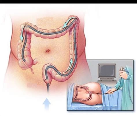 Viêm Loét Đại Tràng Có Nguy Hiểm Không? Triệu Chứng Và Cách Điều Trị