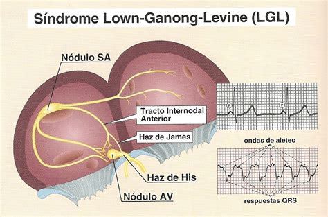 Dr. Rafael Soto - Electrocardiografía - Cardiología clínica: Síndrome de Lown-Ganong-Levine (LGL)