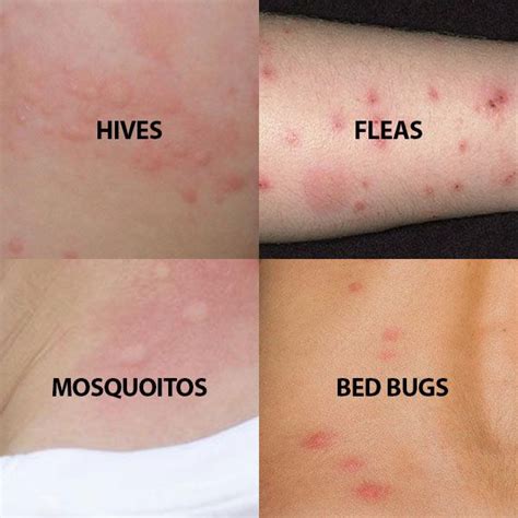 Luxury Bed Bug Bites Look Like