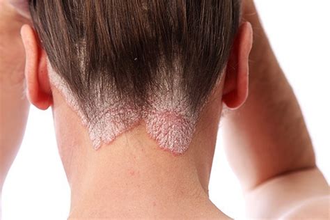 How to Treat and Manage Scalp Psoriasis | Hairborist