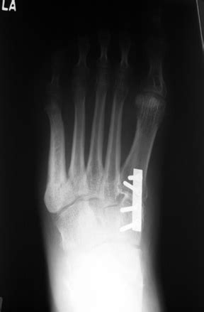 picture114.jpg [Foot Alignment]