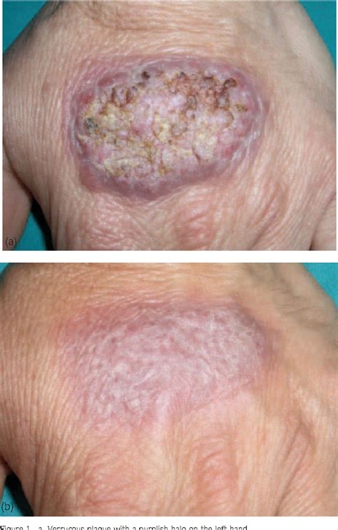 Figure 1 from Coexistence of Tuberculosis Verrucosa Cutis with Scrofuloderma | Semantic Scholar