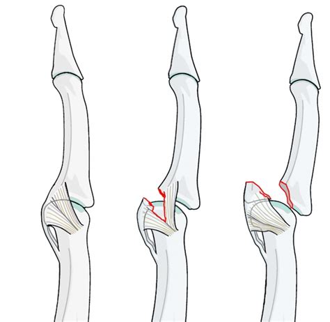 Volar Plate Injuries (Jammed Finger) Proximal Phalangeal Joint fractures – The Lothian Hand Unit