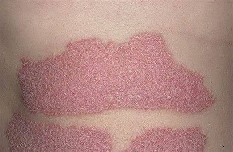 Plaque psoriasis symptoms pictures | Symptoms and pictures