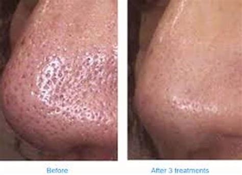 Microdermabrasion Blackheads Before And After