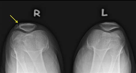 Bipartite patella – Radiology Cases