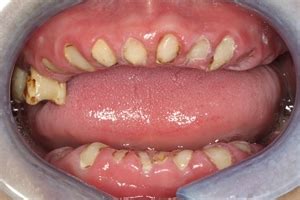 Do tooth roots need to be removed | News | Dentagama