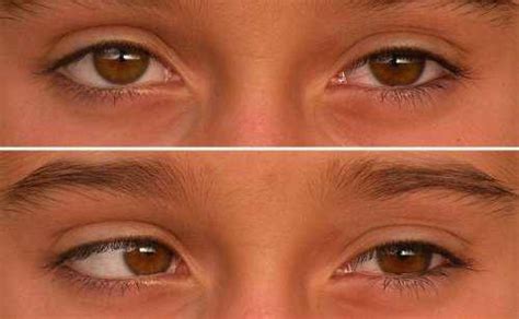 Eyes and Vision as related to Amblyopia - Pictures