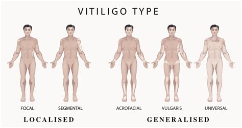 What is Vitiligo? | Causes, Signs, Symptoms, & More | Vitiligo Society