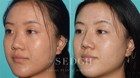 Los Angeles Asian Rhinoplasty | West Hollywood Asian Nose Job Surgery