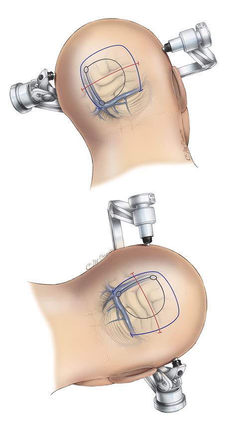 Occipital Craniotomy | The Neurosurgical Atlas