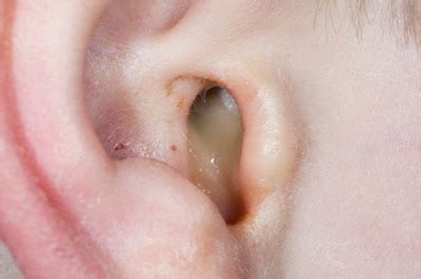 Ear Infection