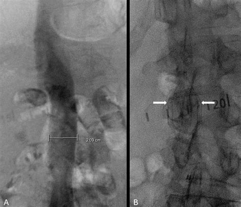 Inferior Vena Cava Filter Migration to the Right Ventricle: A Case Report and Review of Filter ...