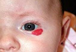 Capillary Hemangioma Eye