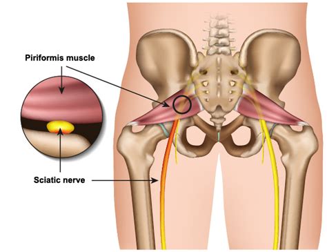 How to Heal Piriformis Syndrome Quickly | Petersen Physical Therapy