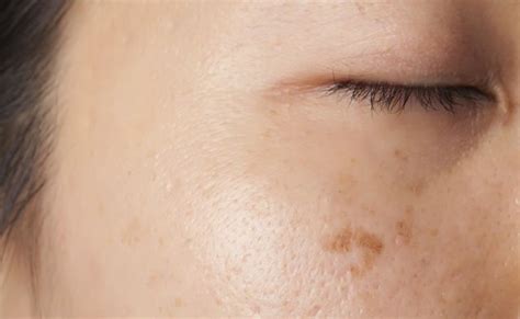 7 Natural Remedies For Dark Spots | Prevention